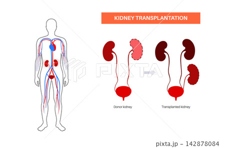 Kidney transplant surgery 142878084