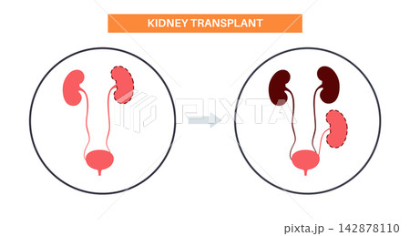 Kidney transplant surgery 142878110