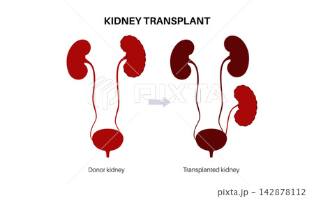 Kidney transplant surgery 142878112