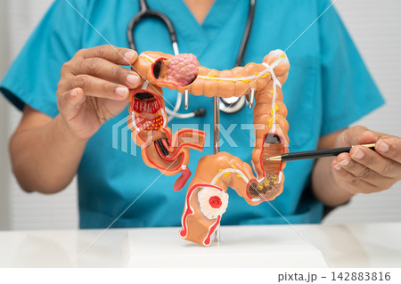 Colorectal cancer, doctor holding intestine colon human model. Colorectal cancer, doctor holding intestine colon human model. 142883816