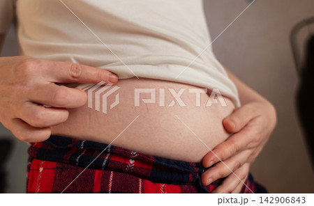 Woman touching stretch marks on belly skin. Close up of female hands holding stomach with striae after pregnancy or weight loss. Woman touching stretch marks on belly skin. Close up of female hands holding stomach with striae after pregnancy or weight loss. 142906843