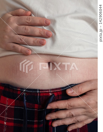Woman touching stretch marks on belly skin. Close up of female hands holding stomach with striae after pregnancy or weight loss. Woman touching stretch marks on belly skin. Close up of female hands holding stomach with striae after pregnancy or weight loss. 142906844