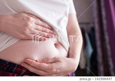 Close-up of a woman touching elastic waistband marks on her stomach skin. Tight clothing imprint caused by uncomfortable waistband and skin pressure. Close-up of a woman touching elastic waistband marks on her stomach skin. Tight clothing imprint caused by uncomfortable waistband and skin pressure. 142906847