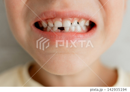 Extreme macro view of child open mouth showing gap after losing front primary milk tooth. Pediatric dental care, healthy gums, tooth fairy, and natural growing up process 142935194