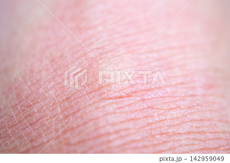 Skin allergy rash dermatitis texture close up Skin allergy rash dermatitis texture close up 142959049
