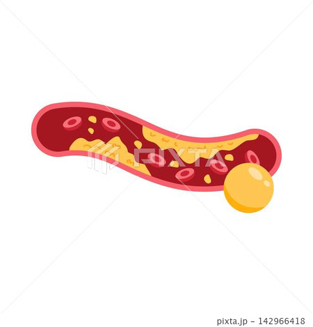 LDL cholestreol in artery 142966418