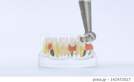 Professional oral hygiene concept showing a dental drill with polishing brush cleaning teeth on a transparent jaw model. 142972027