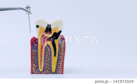 Endodontic treatment concept showing metal tweezers holding a dental file near a cross section anatomical model of a decayed tooth with copy space. 142972029