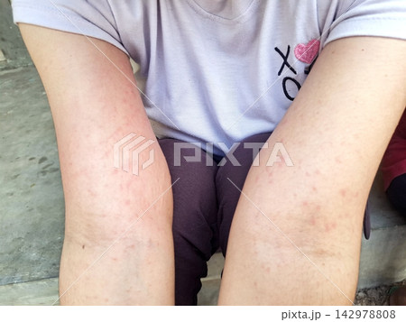 Close up of small red bumps on young skin, pediatric dermatology symptoms, irritation from heat or contact dermatitis, childhood health issue. Close up of small red bumps on young skin, pediatric dermatology symptoms, irritation from heat or contact dermatitis, childhood health issue. 142978808