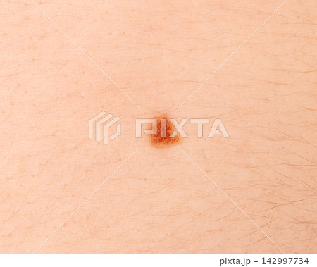 Skin mole closeup. Macro photo of blemish similar to melanoma Skin mole closeup. Macro photo of blemish similar to melanoma 142997734