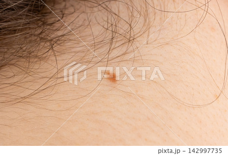 Skin mole closeup. Macro photo of blemish similar to melanoma 142997735