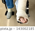70代女性の骨折した足 70代女性の骨折した足 143002185