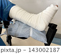 70代女性の骨折した足 70代女性の骨折した足 143002187