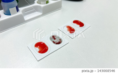 Blood group and Rh factor testing by slide agglutination method. Blood type test 143008546