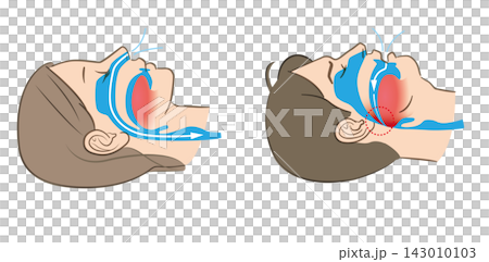 睡眠呼吸中止症和正常呼吸的圖示 睡眠呼吸中止症和正常呼吸的圖示 143010103