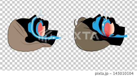 Illustration of sleep apnea syndrome and normal breathing Illustration of sleep apnea syndrome and normal breathing 143010104