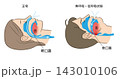 睡眠時無呼吸症候群と正常な呼吸のイラスト 143010106