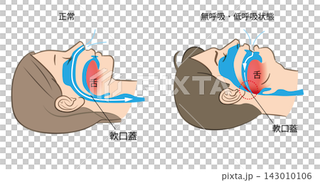 Illustration of sleep apnea syndrome and normal breathing Illustration of sleep apnea syndrome and normal breathing 143010106