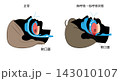 睡眠時無呼吸症候群と正常な呼吸のイラスト 143010107