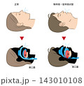 睡眠時無呼吸症候群と正常な呼吸のイラスト 143010108