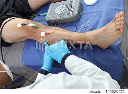 Electromyography in the lower limbs, graphic recording technique of the electrical activity produced by the tibial muscle performed by a specialist neurologist Electromyography in the lower limbs, graphic recording technique of the electrical activity produced by the tibial muscle performed by a specialist neurologist 143020472