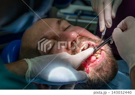 Dental team tightening implant-supported restoration with torque instrument Dental team tightening implant-supported restoration with torque instrument 143032440