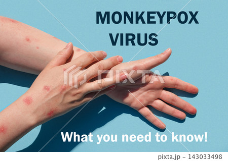 Phrase MONKEYPOX VIRUS what you need to know. Monkeypox new disease dangerous over the world. Patient with Monkey Pox. Painful rash, red spots blisters. Close up human hands with Health problem 143033498