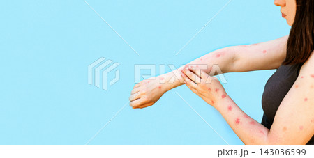 Monkeypox new disease dangerous over the world. Patient with Monkey Pox. Painful rash, red spots blisters on the hand. Close up rash, human hands with Health problem. Banner, copy space Monkeypox new disease dangerous over the world. Patient with Monkey Pox. Painful rash, red spots blisters on the hand. Close up rash, human hands with Health problem. Banner, copy space 143036599