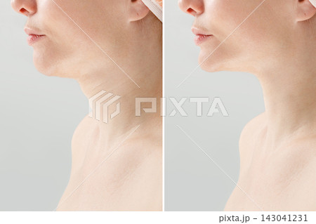 Before and After Facial Rejuvenation with Improved Chin and Jawline Contour 143041231
