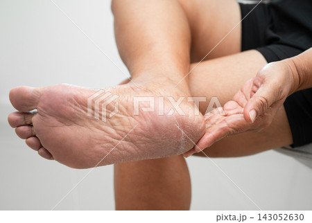 Asian woman check feet with crack and dry heel skin, Diabetic Foot. Asian woman check feet with crack and dry heel skin, Diabetic Foot. 143052630