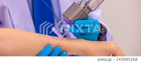 Laser Machine.Young woman receiving laser treatment.Skin Care. 143095208