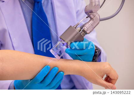 Laser Machine.Young woman receiving laser treatment.Skin Care. 143095222
