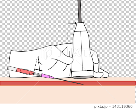 超音波ガイド下血管穿刺③ 長軸像 外筒のみを進める操作の医療イラスト 超音波ガイド下血管穿刺③ 長軸像 外筒のみを進める操作の医療イラスト 143119360