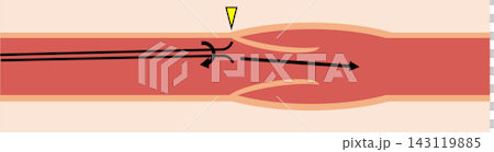 PICC insertion procedure troubleshooting: Diagram illustrating the guidewire contacting a venous valve. PICC insertion procedure troubleshooting: Diagram illustrating the guidewire contacting a venous valve. 143119885