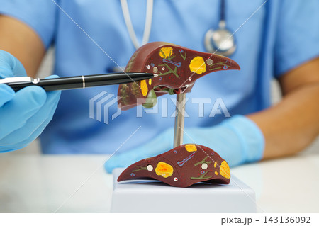 Cirrhosis, Liver cancer, fatty liver, Asian doctor with liver human anatomy model in World Hepatitis Day at hospital. Cirrhosis, Liver cancer, fatty liver, Asian doctor with liver human anatomy model in World Hepatitis Day at hospital. 143136092