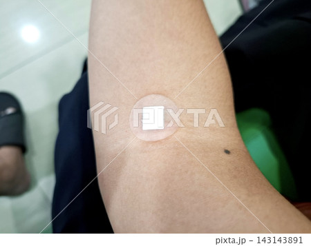 Adhesive medical patch applied on human arm skin for drug delivery or wound healing. Adhesive medical patch applied on human arm skin for drug delivery or wound healing. 143143891
