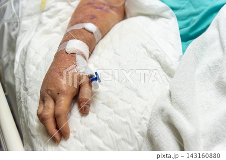 Close up of patient hand intravenous cannula medical tape resting hospital bed showing inpatient treatment healthcare recovery concept 143160880