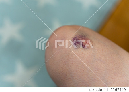 膝にできた濃いあざ・打撲痕のクローズアップ写真 143167349