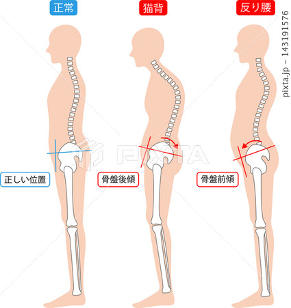正しい姿勢と猫背と反り腰 全身　背骨と骨盤 143191576