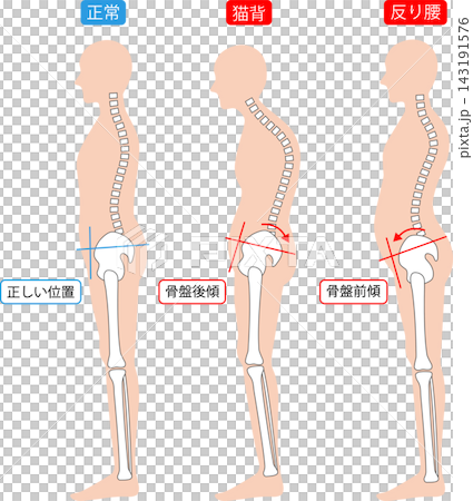 正しい姿勢と猫背と反り腰 全身　背骨と骨盤 143191576