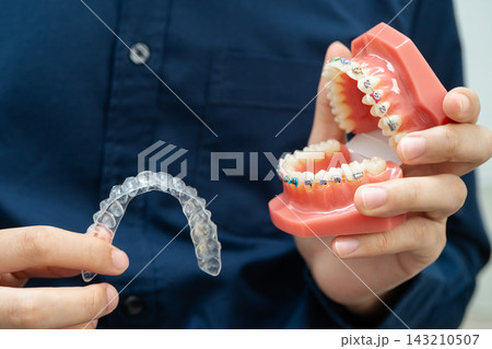 Man holding invisible aligner orthodontic retainer for dental teeth straightening. Man holding invisible aligner orthodontic retainer for dental teeth straightening. 143210507