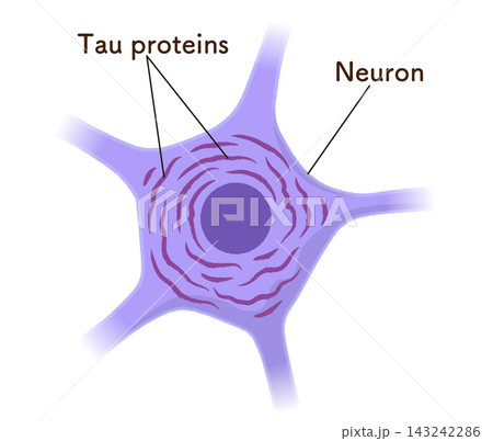 Alzheimer's disease brain, Tau protein Alzheimer's disease brain, Tau protein 143242286