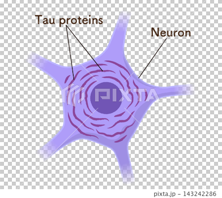 Alzheimer's disease brain, Tau protein Alzheimer's disease brain, Tau protein 143242286