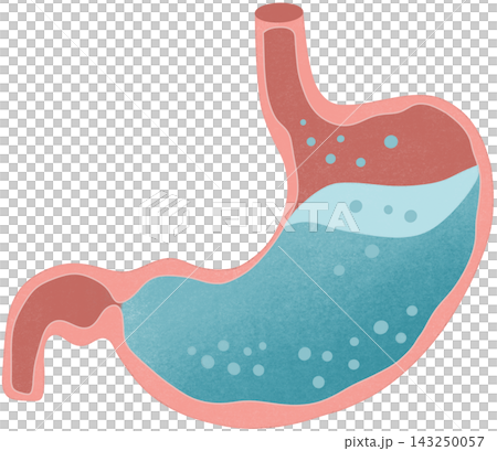 gastroesophageal reflux illustration 143250057