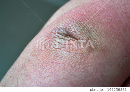 Close up dry flaky skin on elbow, caused by psoriasis. 143256831