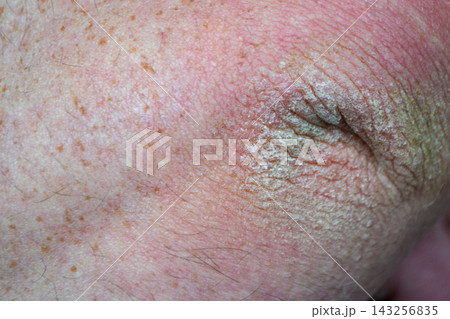 Close up dry flaky skin on elbow, caused by psoriasis. 143256835