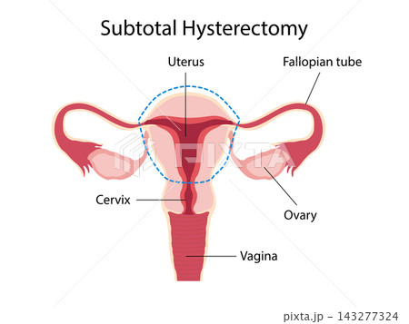 Subtotal Hysterectomy Subtotal Hysterectomy 143277324
