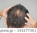 抜け毛・薄毛に悩む男性① 143277361
