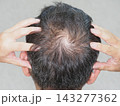 抜け毛・薄毛に悩む男性② 143277362