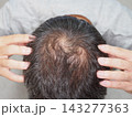 抜け毛・薄毛に悩む男性③ 143277363